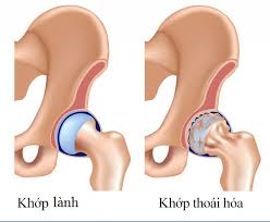 Thoái hoá khớp: Thách thức trong chuẩn đoán và điều trị (phần 1)