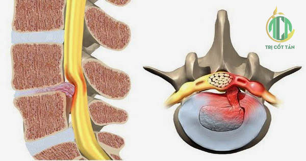 Hẹp ống sống: những điều cần biết