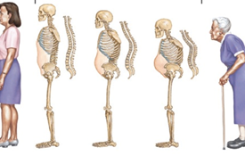Loãng xương và gãy xương ở người cao tuổi