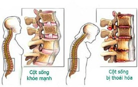 60% người Việt bị thoái hoá cột sống