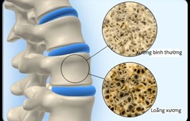 Hỏi đáp về gen và loãng xương