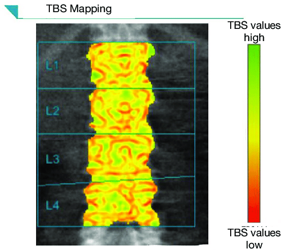 Ảnh hưởng của yếu tố di truyền lên chỉ số xương bè (TBS)