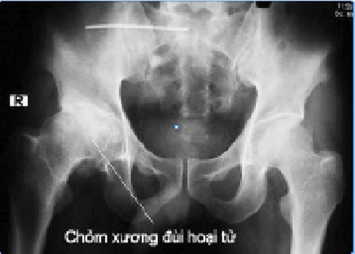 Hoại tử xương: những điều cần biết