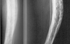 Bệnh Paget xương: chẩn đoán và điều trị