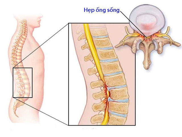 Hẹp ống sống: thông tin về điều trị