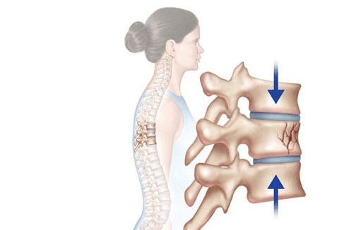 Phát hiện gãy xương đốt sống do loãng xương