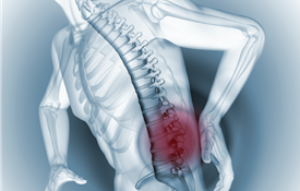 Gãy xương cột sống do loãng xương