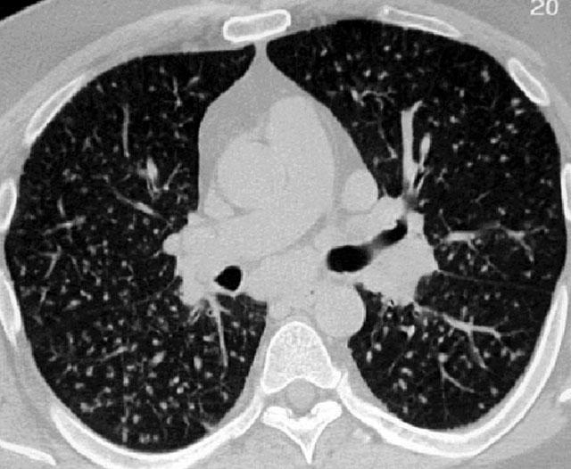 Sarcoidosis