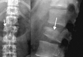 Loãng xương: căn bệnh thầm lặng