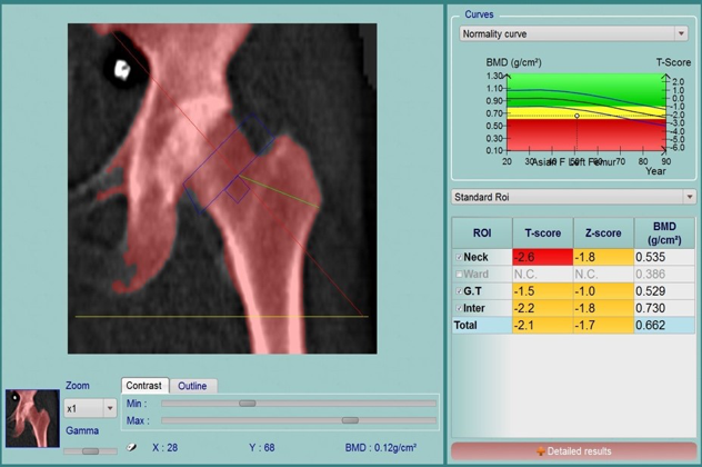 Đo mật độ xương bằng phương pháp DEXA