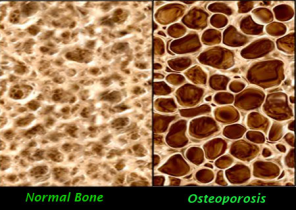 Figure 1Mật độ xương bình thường và ở bệnh loãng xương