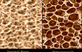 TỔNG HỢP CÁC BÀI GIẢNG VỀ LOÃNG XƯƠNG CỦA GIÁO SƯ NGUYỄN VĂN TUẤN