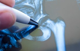 Tử vong từ một đường gãy: hiểu mối liên hệ giữa gãy xương do loãng xương và tỉ lệ tử vong.